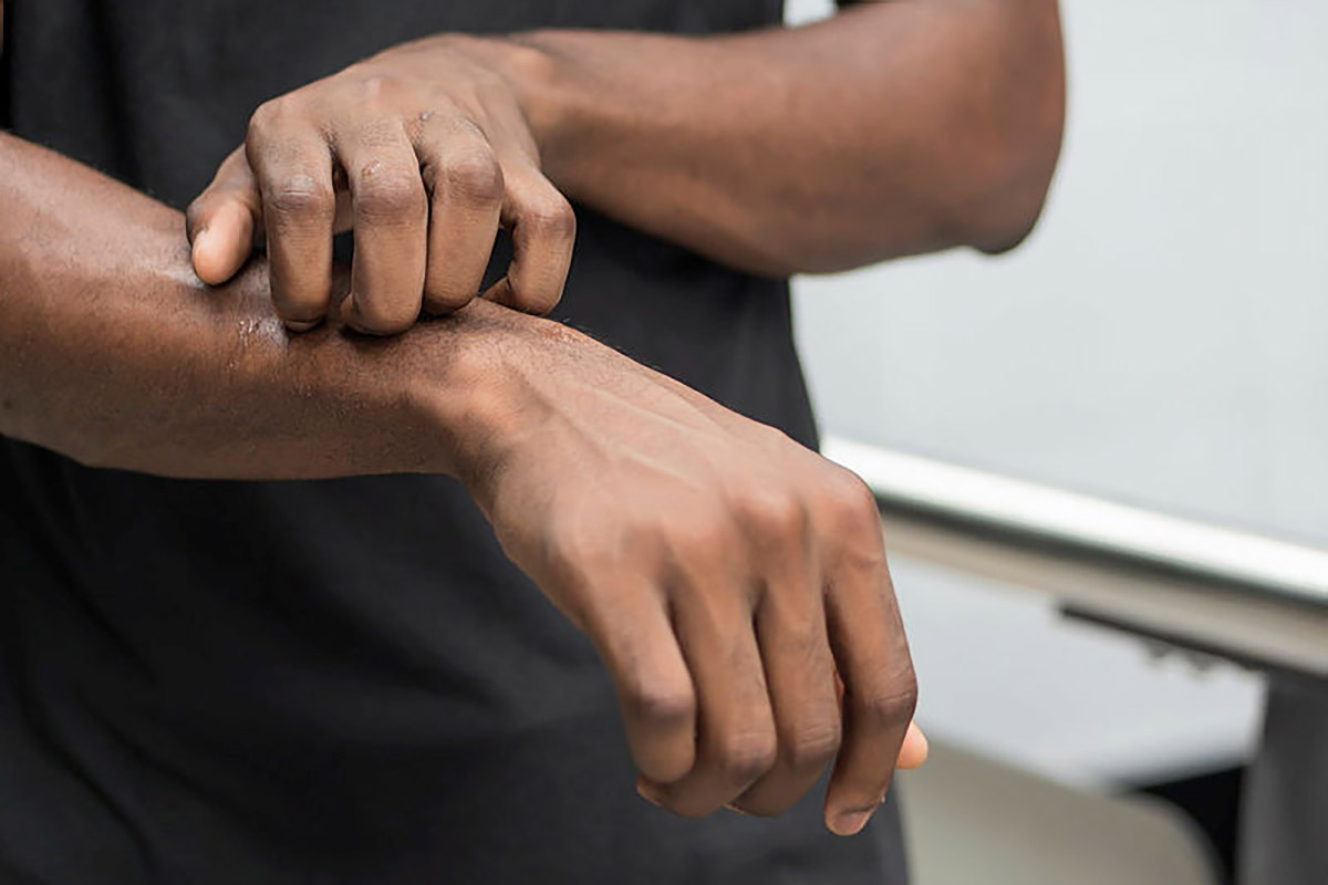 Man suffering from itching skin; sick african man scratching his skin.