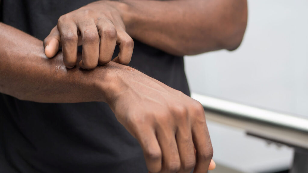 A person scratching the top of their forearm with their opposite hand, suggesting irritation or an itchy skin condition.