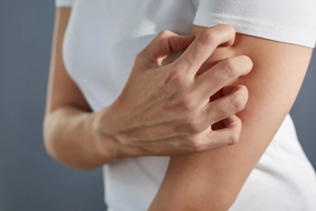 Close-up of a person scratching the upper arm with one hand. The person is wearing a white short-sleeved shirt, and the image focuses on the arm and hand, suggesting skin irritation or itching.